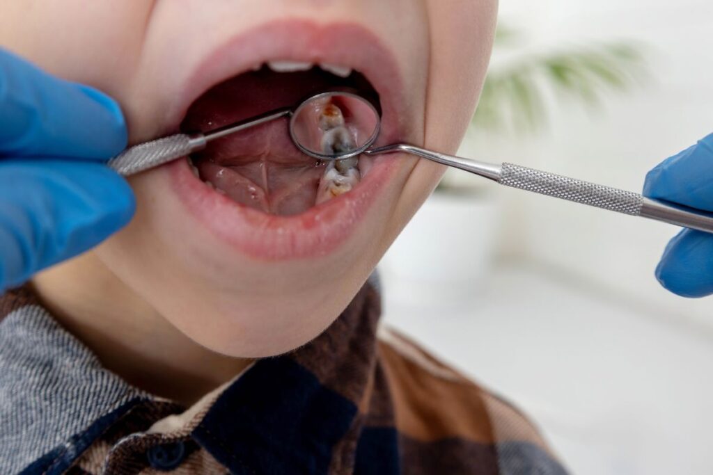 Child receiving a dental filling for tooth decay