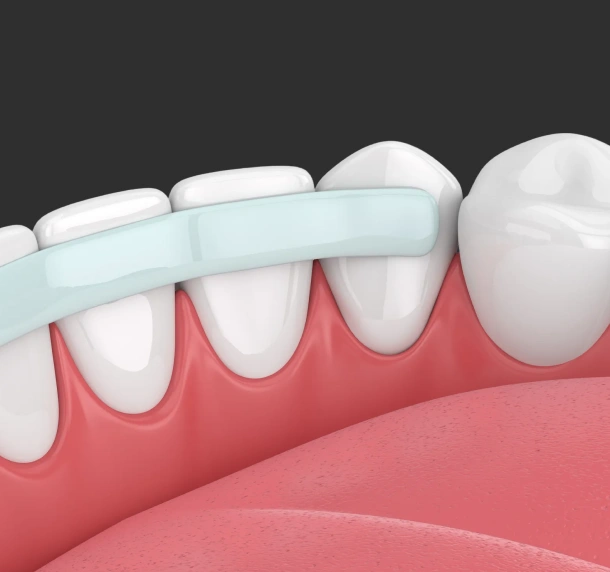 Dental bridge restoration showing artificial tooth replacing missing tooth between natural teeth.