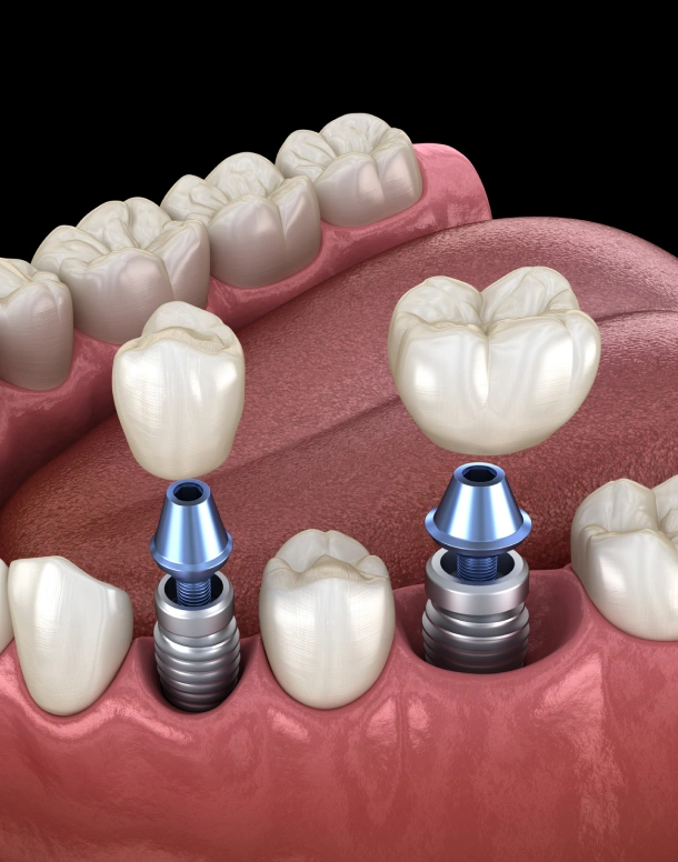 Dental implants with prosthetic crowns displayed on pink gum model showing implant structure and placement.