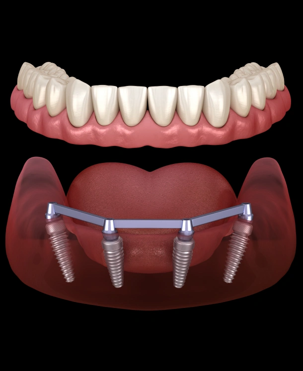 Dental implant prosthetic comparison showing artificial teeth bridge above implant fixtures in gum tissue.