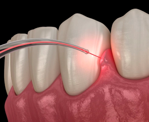 Dental-Laser