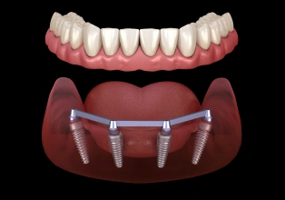 Denture-Implants