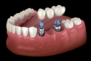 Implant-Supported-Bridge