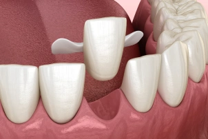 Resin-Bonded-Bridge