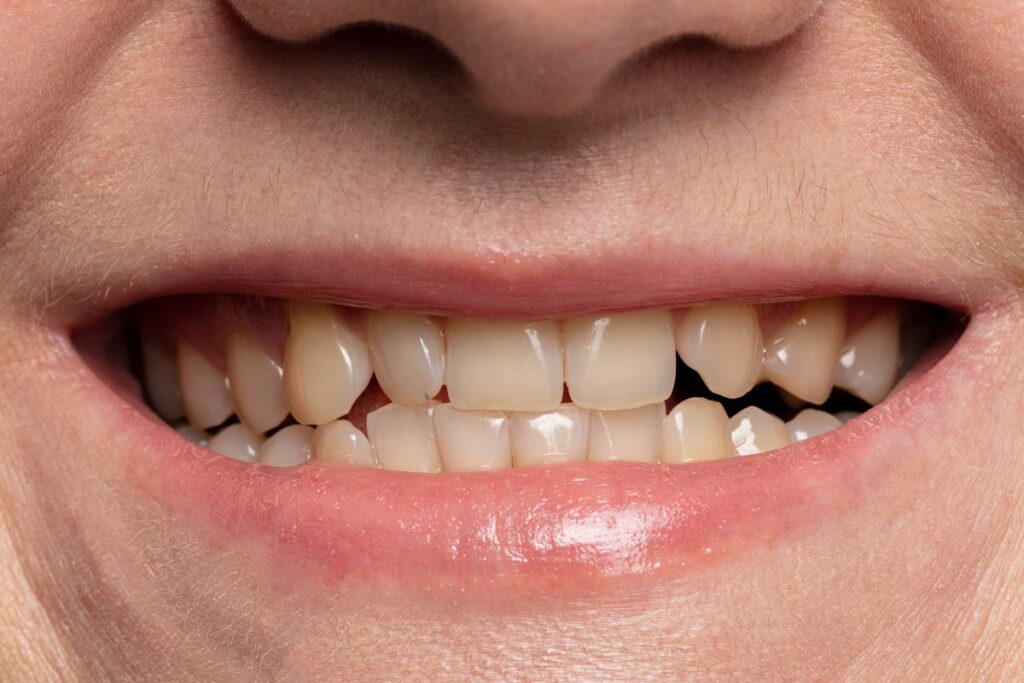 Cosmetic dentist Chelmsford using dental bonding for uneven tooth